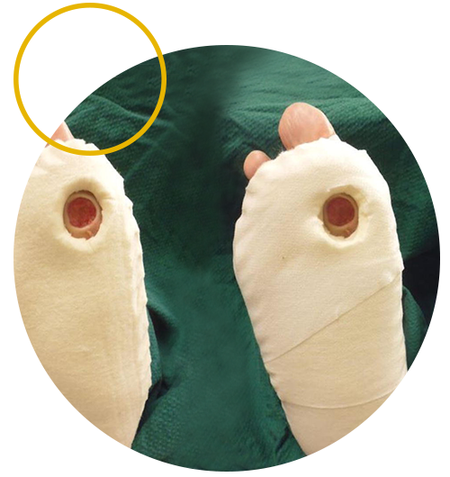 Offloading Wound Care